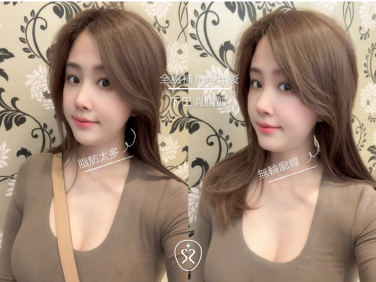 全臉補脂後代謝慢水腫困擾